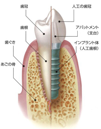 インプラント治療とは